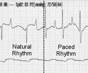 ECG