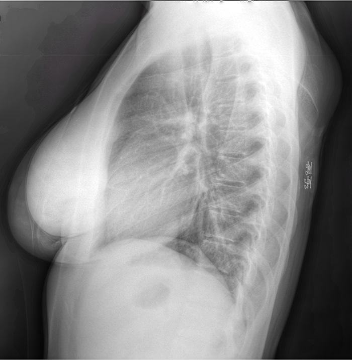 A black and white ultrasound image of a female torso in profile.