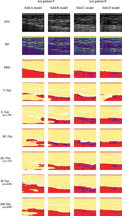 Ultrasound images in black and white top a grid of blocks that show how the W-Net convolutional neural network makes the images clearer with red, light yellow and blue highlighting specific areas in the ultrasound.